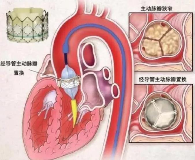 主动脉瓣狭窄和主动脉瓣置换术