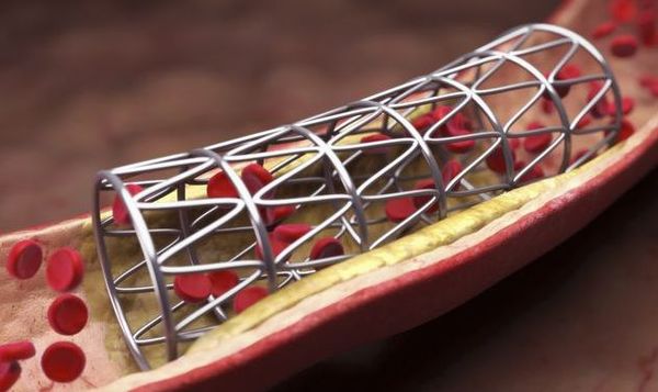 做了支架手术就可以高枕无忧吗?